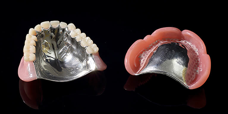 金属床義歯（自由診療の入れ歯）